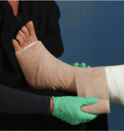 Venous Ulcer Care Guide