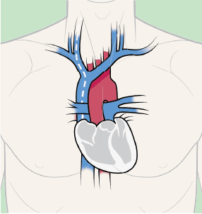 What Defines a Central Venous Catheter (CVC)?