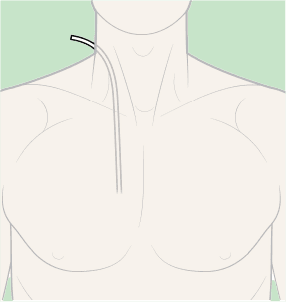 Guidewire Positioning in CVC Insertion (Best Practices)