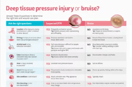 Distinguishing Deep Tissue Pressure Injuries from Bruises