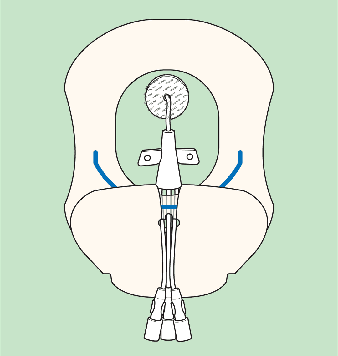 Maintaining Fully Intact Central Line Dressings